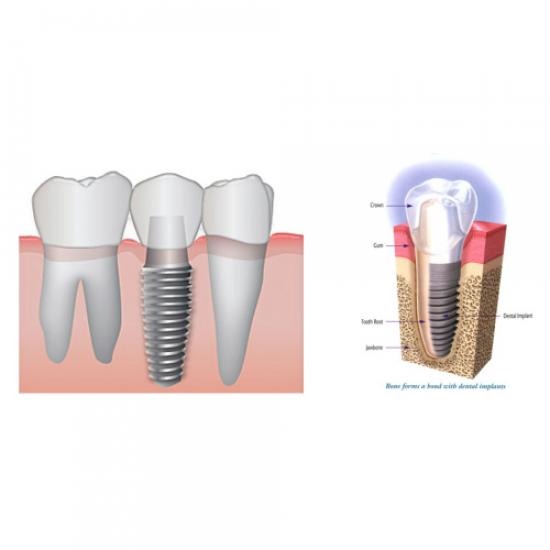 รักษารากฟัน เชียงใหม่ รักษารากฟัน เชียงใหม่  รักษารากฟัน 