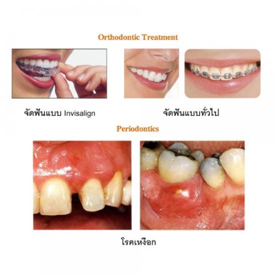 รักษาเหงือก เชียงใหม่  